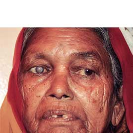 Lady with Cataract
